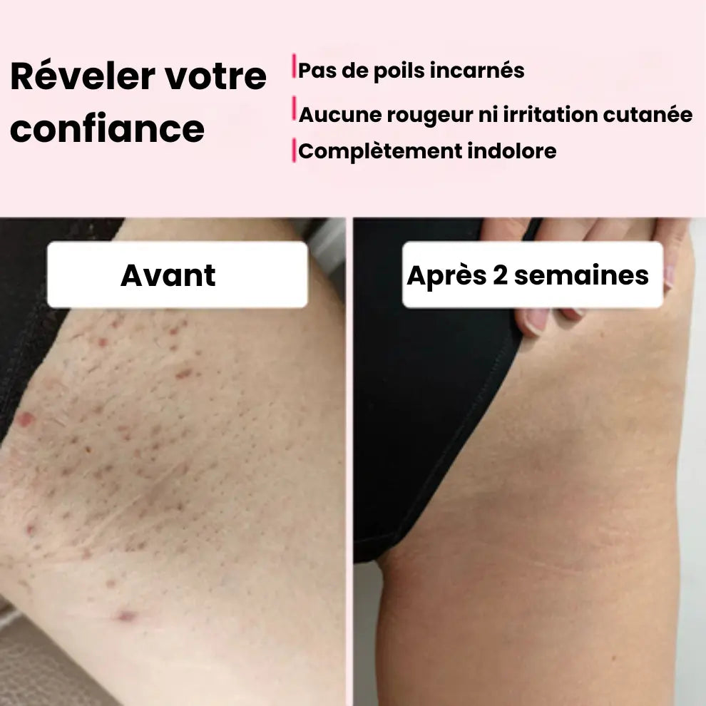 Épilateur IPL kleeya™